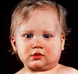 Bebeklerde Lenf Bezi Özellikleri ve Faydaları Nelerdir? Bebeklerde Lenf Bezi Özellikleri ve Faydaları Nelerdir?