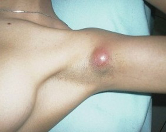 Koltuk Altı Lenf Bezi İltihabı Belirtileri ve Tedavisi