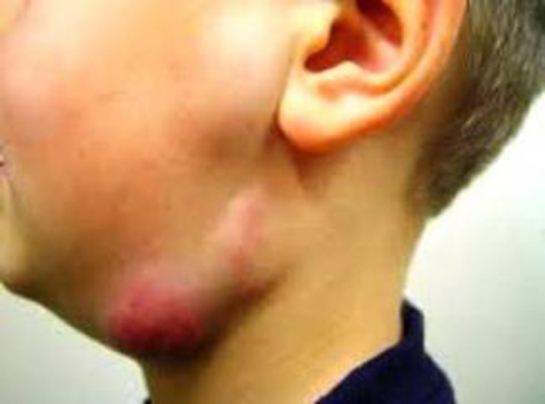 Lenf Bezi İltihabı Belirtileri ve Tedavisi