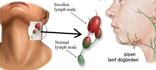Lenf Bezi Kanseri Belirtileri ve Tedavisi