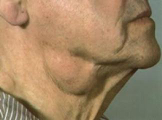 Lenf Bezi Veremi Belirtileri ve Tedavisi