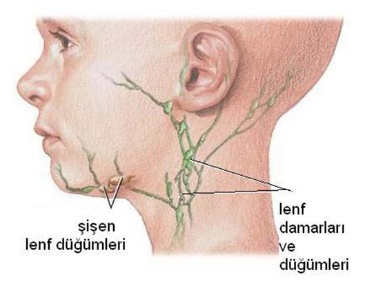 Lenf Bezlerinin Grevi