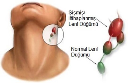 Lenf Düğümleri Özellikleri ve Faydaları Nelerdir?